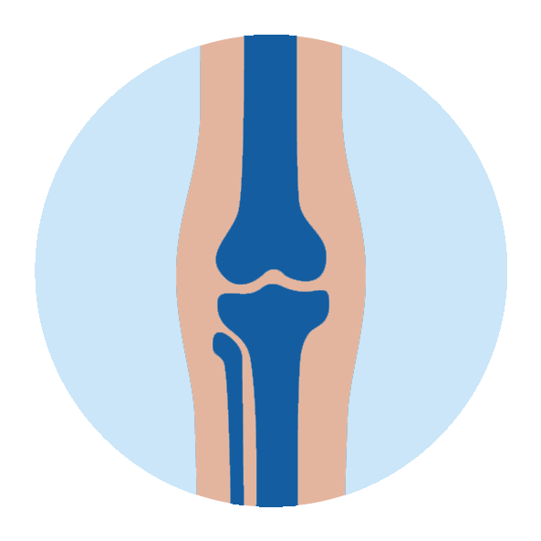 Illustration of a human knee joint with bones and cartilage highlighted in blue.