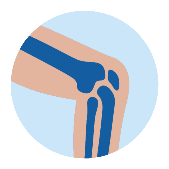 Illustration of a human knee joint showing bones in blue and beige, against a light blue background.